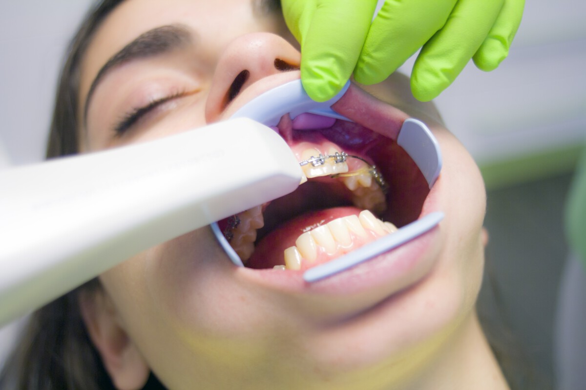 Vergoeding orthodontie